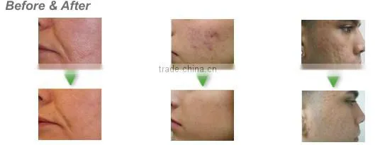 Medical Use CO2 Fractional Laser Scar Removal/fractional Co2 Laser in Dermatology photo-4
