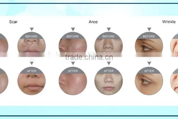 CO2 Fractional Laser Machine Scar And Birth Mark Removal Acne Removal In Beatuty Equipment Carboxytherapy photo-6
