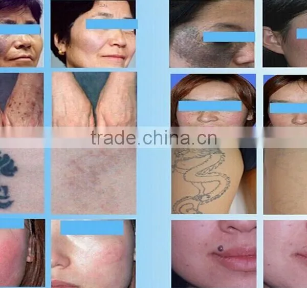 Q-switch Nd Yag Laser Skin Rejuvenation Mongolian Spots Removal Tatoo Removal Machine With CE From Sanhe Haemangioma Treatment photo-6