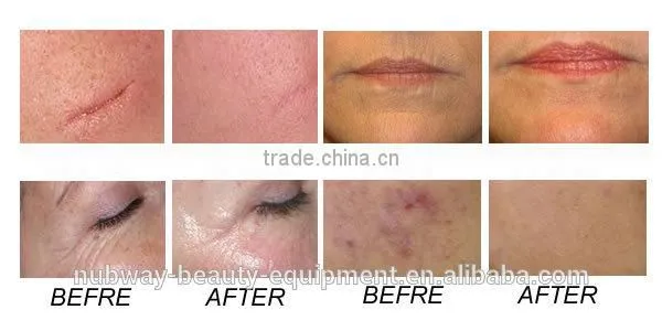 10600nm Safe And No Effect Co2 Fractional Vagina Cleaning Laser Pigment Removal Skin Nurse Machine photo-5