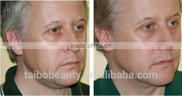 RF Micro Needle Tightening Radio Frequency/RF Skin Lifting Radio Frequency/skin Rejuvenation Radio Frequency photo-6