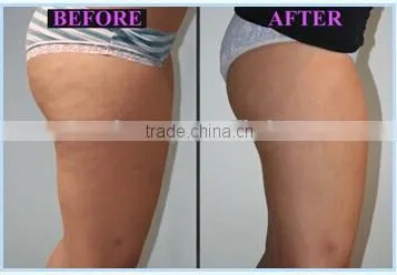 Cool Body Sculpting Criolipolysis Weight Loss Machine With 3 Cryo Handles photo-5