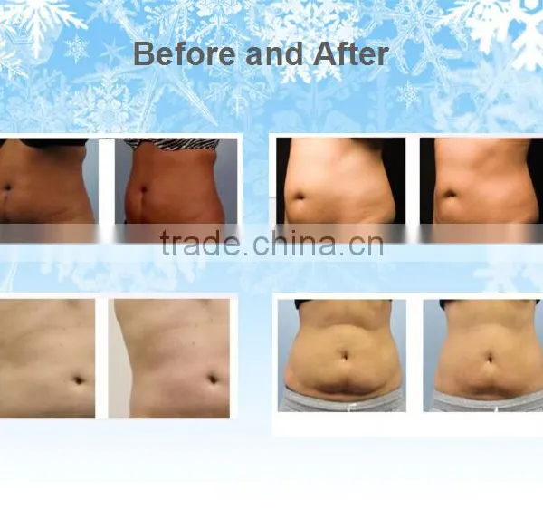 New Professional Cryolipolysis Fat Removal Body Contouring Beauty Equipment photo-3