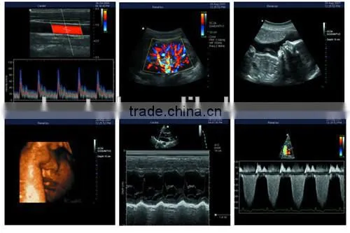 High Quality 3D Color Doppler Ultrasound Machine With Internal Report photo-3