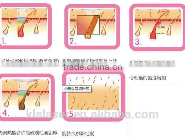 Abdomen 808 Diode Laser Hair Removal Machine Permanent Hair Removal For Men Pigmented Hair photo-5