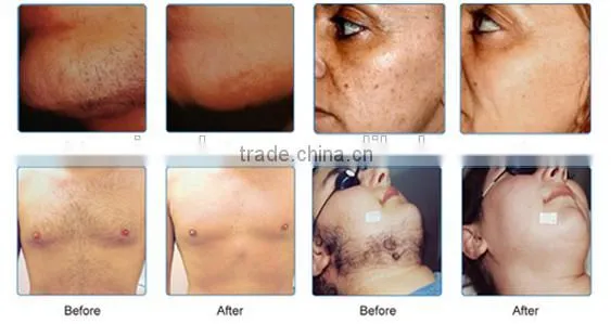 Factory Supplier!!!Professional IPL Laser Skin Rejuvenation / IPL Hair Removal Machine photo-6