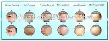 Anybeauty 2 Handpiece Salon Vertical no Pain Ipl SHR Hair Lost Machine / SHR Spare Parts Hair Removal Machine for Sale photo-5