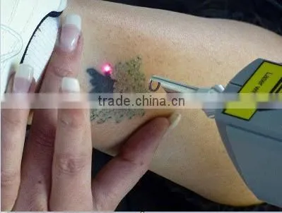 Laser Skin Treatment Machines Laser Ndyag 800mj Tattoo Removal Machine Brown Age Spots Removal photo-2