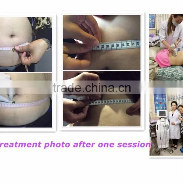 Slimming Beauty Machine Liposonix Depilatory Machine photo-5