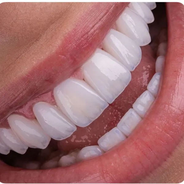 Dental Lab Custom Alloy Framework for German Dental Clinic photo-5