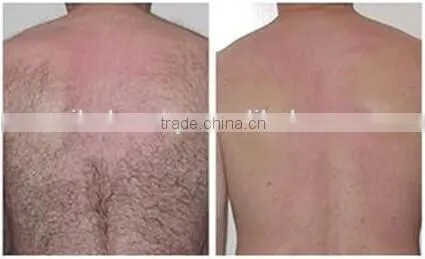 Multifunction Portable Ipl Shr Breast Lifting Up Laser Hair Removal Machine photo-3
