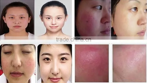 EVLT Laser Spider Vein Removal 980 nm Diode Laser for Whole Body Vascular Lesion Removal photo-6