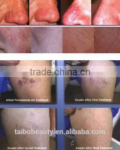 High Frequency RBS Vascular Removal/red Blood Silk Removal/thread Vein Removal Device photo-5