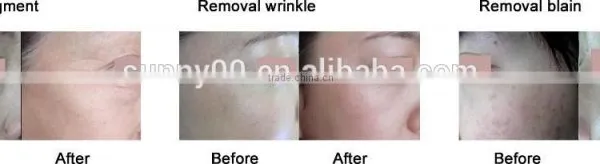 Ultra Pulse Co2 Laser for Skin Resurfacing, Smooth Scars photo-3