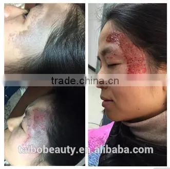 q Switch nd Yag Laser Tattoo Removal Beauty Salon Equipment Supplier photo-5