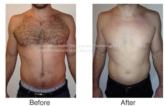 500W Best Diode Laser Hair Removal Beauty Machine photo-5