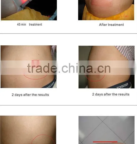 HOT SELLING !!Fat Frozen Equipment Cryolipolysis Slimming Equipment photo-6