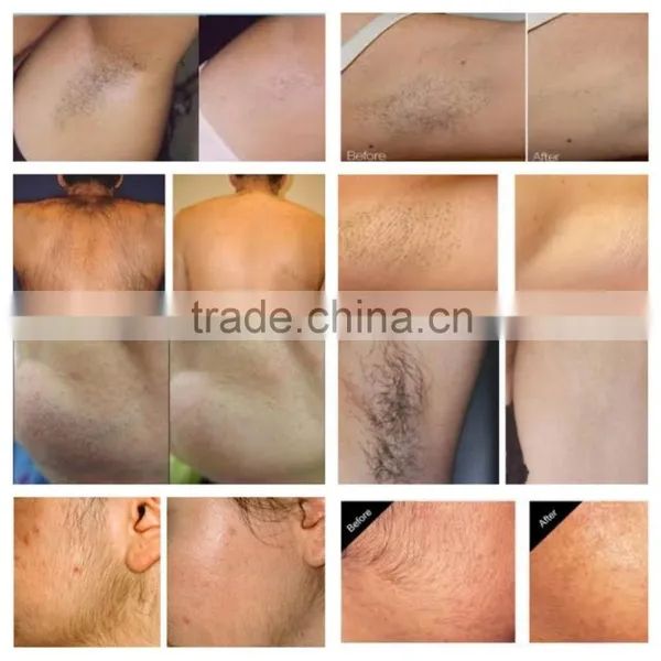 Mutifunctional Elight SHR YAG Laser for Hair Removal Tattoo Removal Skin Rejuvenation Beauty Machine photo-3