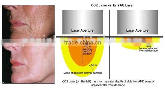 Stretch Mark Removal Acne Scar Removal Laser Laser CO2 Resurfacing Machine From With CE RF Portable Design Fractional Co2 Laser Machine Producers Tumour Removal photo-3