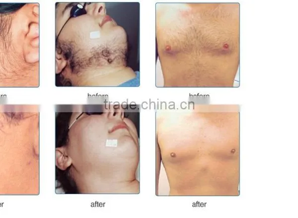 Portable Top Quality Elight Machine Needle Free Bio Skin Rejuvenation photo-3