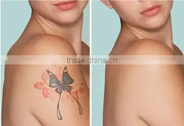 1064nm 532 nm Wavelength Tattoo Removal / Pigmentation Removal nd Yag Laser Machine for Sale photo-6