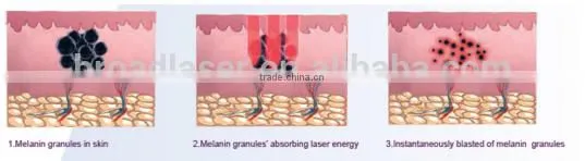 2016 Best Laser Skin Spot Remover Machine photo-5
