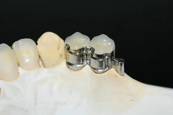Dental Precision Attachment, Dental Attachment, Dental Denture, Laboratoire Dentaire, Dentallabor, Laboratorio Dental, Dental Laboratory, Shenzhen LJ Dental Lab China photo-2