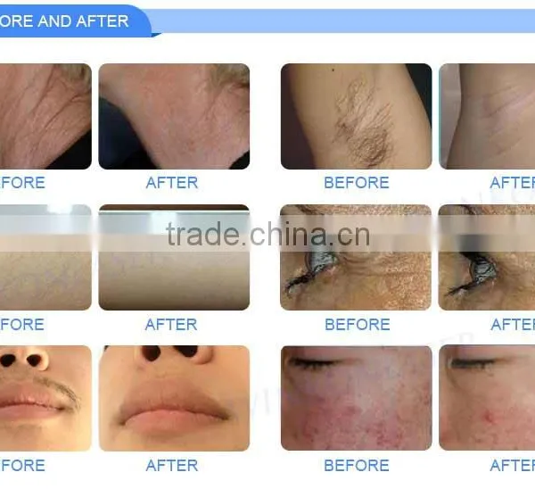 Fast Effect Shr Laser Skin Tightening Opt Hair Removal Machine for Whitening photo-6