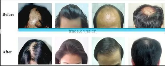 ce Approval Diode Laser Hair Regrowth Machine/laser Cap for Hair Regrowth photo-5