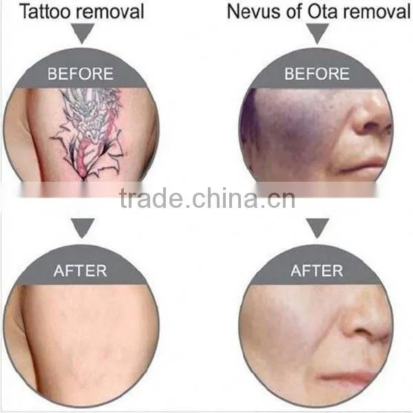 Best China Hot Sale!! Super Fast Color Touch Screen Tattoo Removal Machine on Promotion 10HZ photo-6
