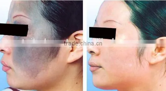 0.5HZ 1064nm 532nm Q Switch Nd Yag Laser Machine Brown Age Spots Removal Remove Pigment And Birthmark Machine Beauty Salon Equipment Supplier photo-6