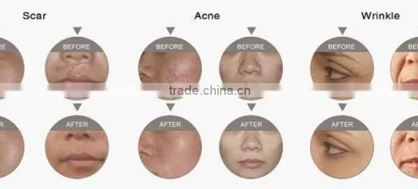 Eliminate Body Odor YUWEI Fractional Co2 Laser Vaginal Tightening & Acne Scar Removal Co2 Laser Machine Vagina Cleaning photo-6