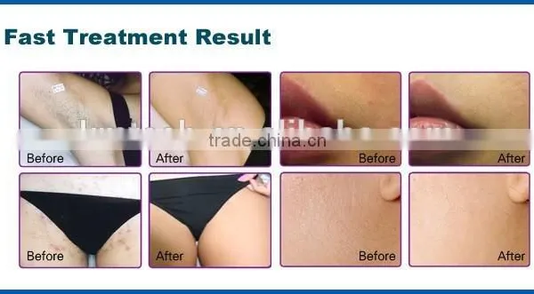 2016 Distributors Wanted Perfect Diode Laser 808nm Hair Removal Device With CE,ROHS photo-4