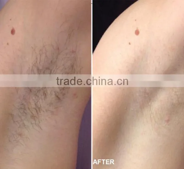 Ipl Rosacea Treatment photo-6