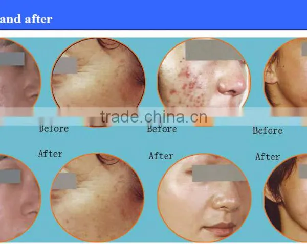 Fractional Co2 Laser Scar and Pigment Removal Device/co2 Laser for Skin Rejuvenation photo-6