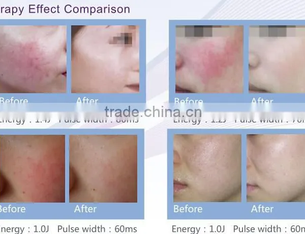 China Top Ten Selling Products Vascular Vein Removal / Varicose Veins Laser Treatment Machine photo-3