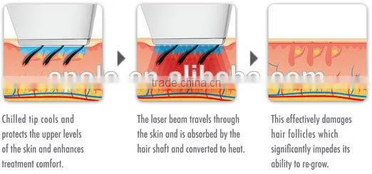 2015 Diode Laser Hair Removal Face Machine For Blond Hair Removal Permanent photo-5