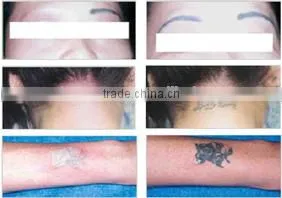 800mj High Quality Q Switched Nd Permanent Tattoo Removal Yag Laser Tattoo Removal/laser Carbon Peeling Machine photo-6