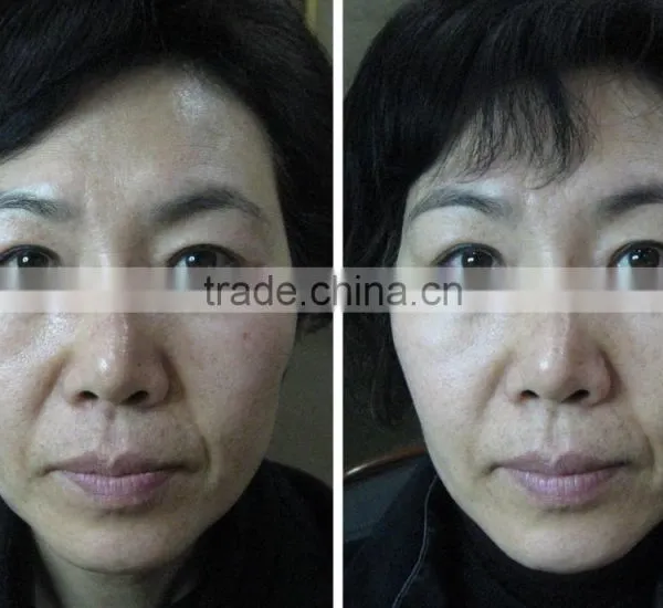 High Frequency Operation System and Anti-Puffiness/Skin Tightening/Wrinkle Remover Feature HIFU Face Lift photo-4