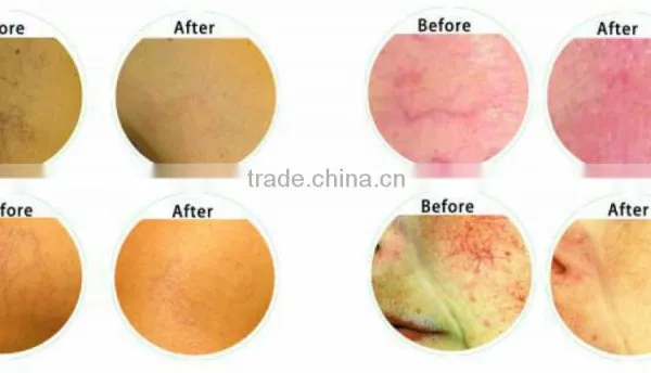Best Selling Products! Laser Vein Removal Machine for Sale 980nm Diode Laser Vascular Removal Thread Vein Removal photo-6