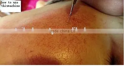 Effective Manufactory Price !!! Only One Treatment! Removing Vascular Vein/blood Vessels/spider Vein Machine photo-6