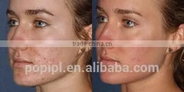 Vagina Tightening Skin Resurfacing Fractional Co2 Laser 8.0 Inch Vaginal RF Tightening Machine With Aluminum Case photo-4