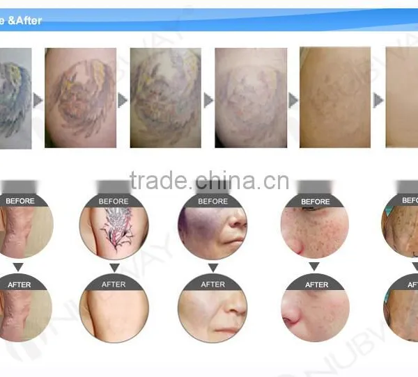 New Products 2016 Innovative Product Q Switch ND YAG Laser Tattoo Removal Machine photo-4