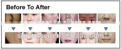 Express Acne Light, Elight Ipl Rf Nd Yag Laser, Light Ipl photo-3