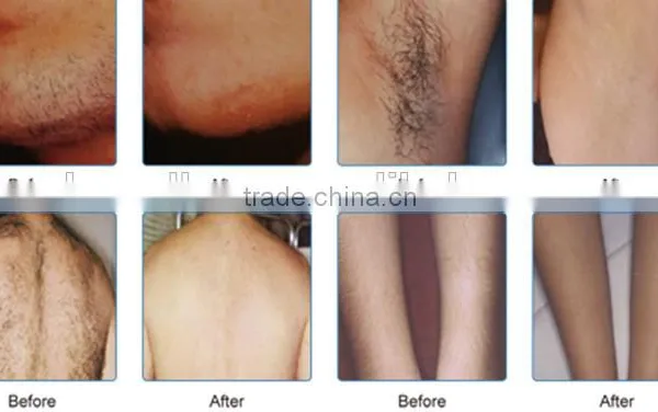 Remove Tiny Wrinkle Shr Ipl Rf Elight Yag Wrinkle Removal Beauty Device IPL Laser Shr Vascular Treatment photo-5