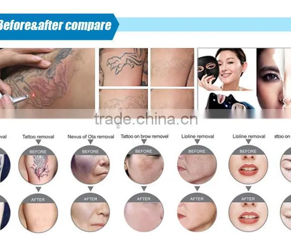 Hot Selling Import Laser Bar Portable Q-switched Nd:yag Laser Tattoo Removal Device photo-6