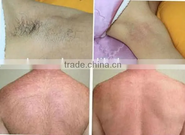 Strong Power!!! 808nm Diode Laser HairRemoval Machines With CE/ HOT!Painless and Powerful Fast Hair Removal 808 DiodeLaser photo-4