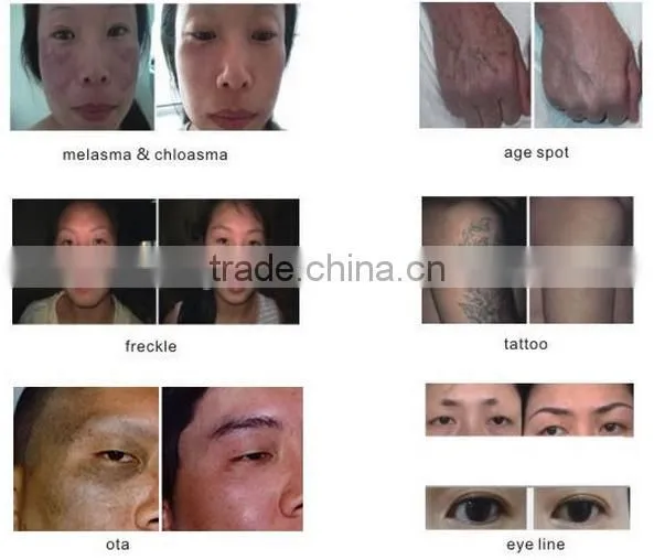 New Laser Handle Best Design nd Yag Laser Price photo-6