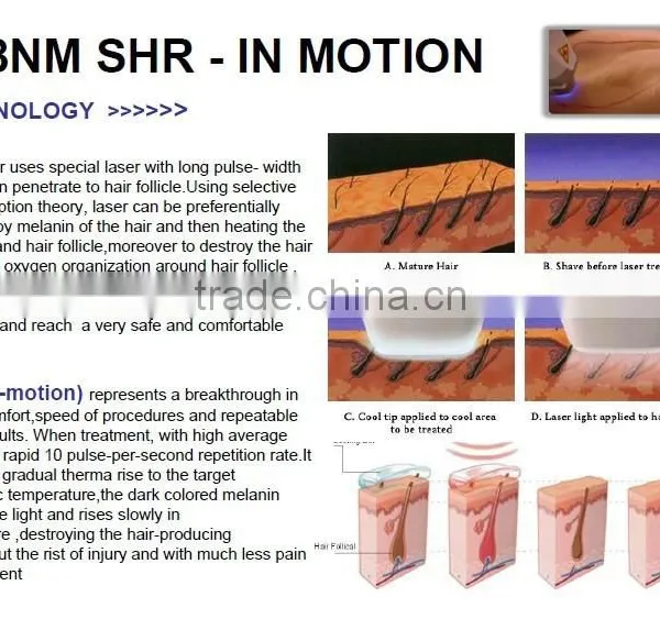 Bikini / Armpit Hair Removal Wanted Distributor 808nm 10-1400ms Diode Laser Hair Removal/laser Hair Removal Machine/808nm Diode Laser photo-5
