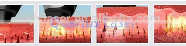 755nm Device / Beauty Machine/ Beauty Equipment Laser Alexandrite to Remove Armpit Hair photo-4
